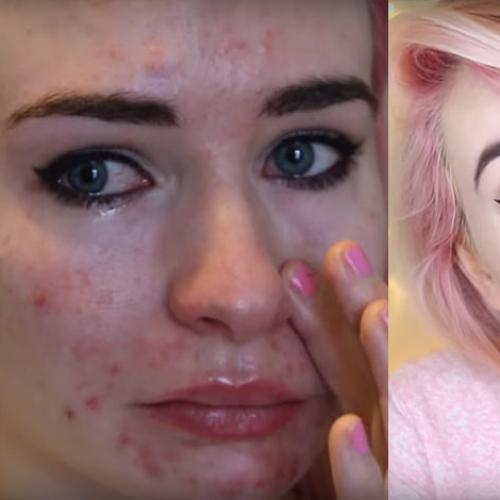 Beauty Blogger Reveals Face Full of Acne During Treatment