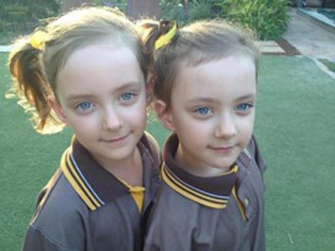Miracle Twins Survive Umbilical Cords Dangerous Entanglement