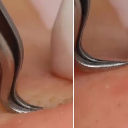 This 'Pain Free Way' Of Removing Acne Is Weirdly Mesmerising